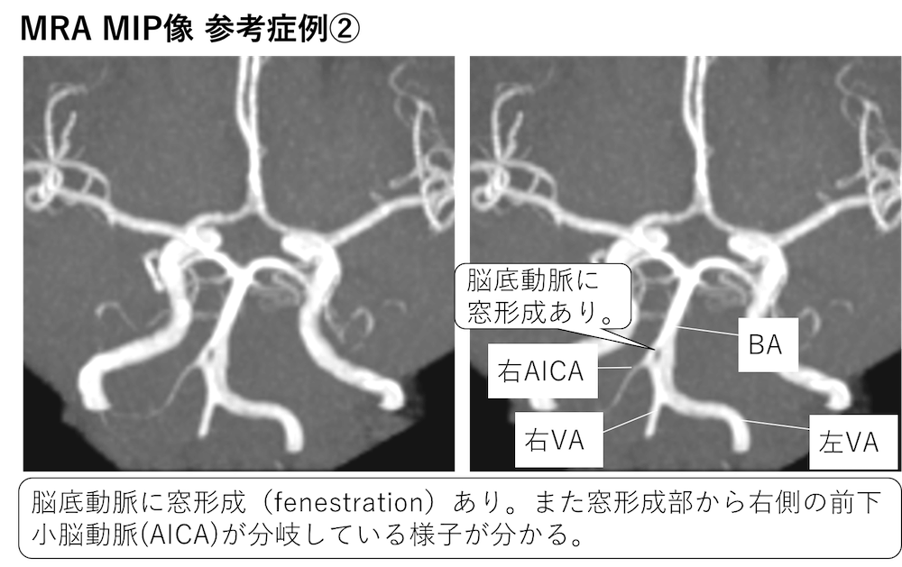 脳のMRAにおける脳底動脈の窓形成（fenestration）とは？